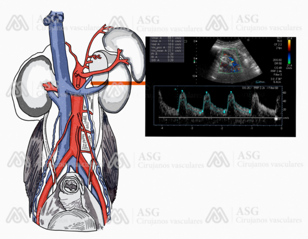 Ecodoppler de Aorta. Aneurisma de Aorta Abdominal (AAA ...